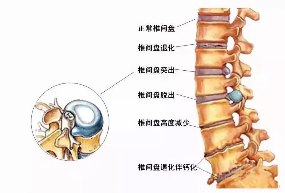 最新腰椎盤(pán)與歡樂(lè)大家庭的互動(dòng)日常