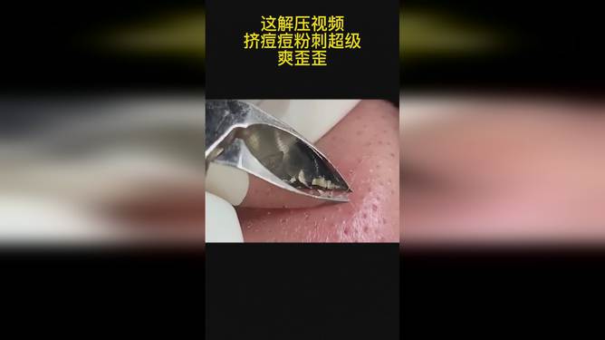 最新擠膿包視頻，見證變化的力量，自信與成就感的誕生之地