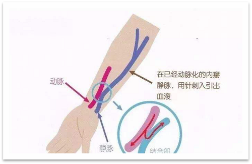 靜脈瘺最新資訊，掌握最前沿的健康信息